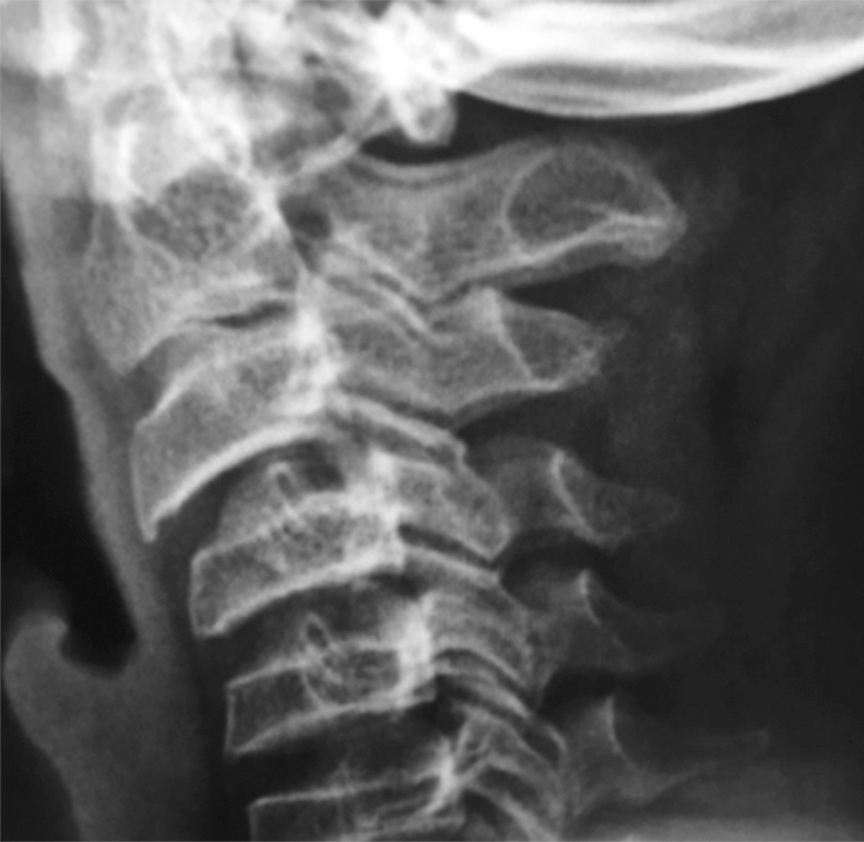 图3 颈椎侧位片.jpg